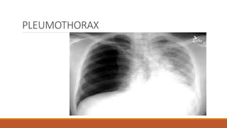 PLEUMOTHORAX
 