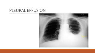 PLEURAL EFFUSION
 
