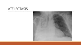 ATELECTASIS
 