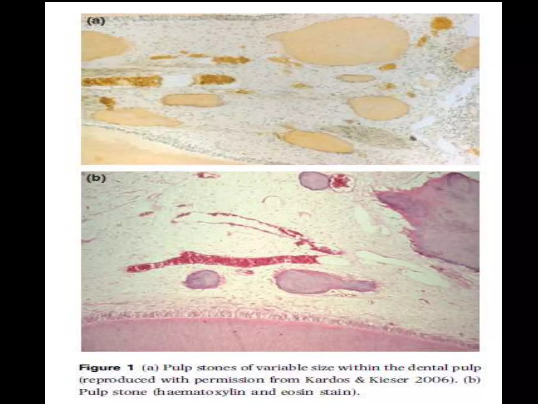 MANAGEMENT OF CALCIFIED PULP CANAL | PPTX