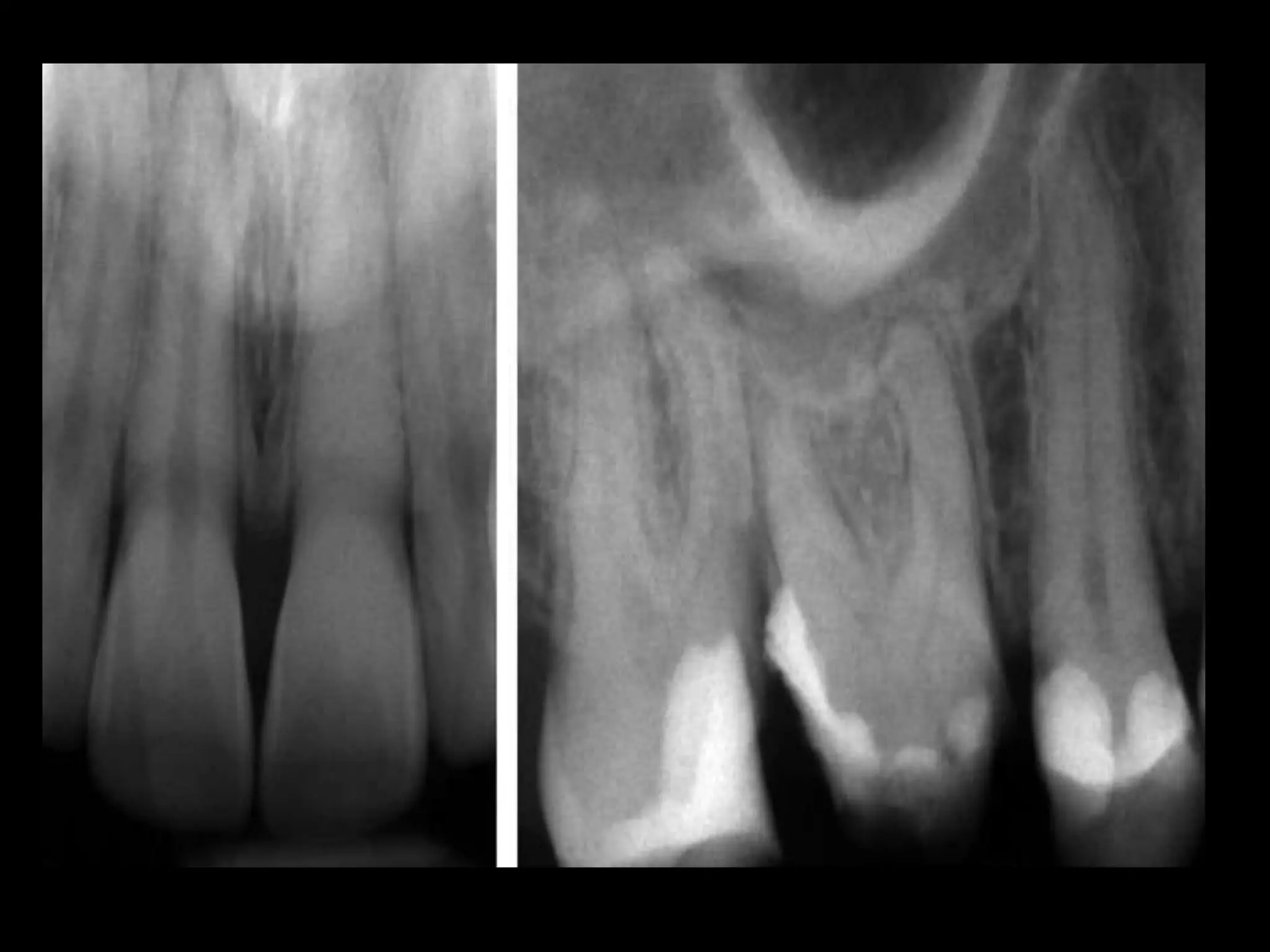 MANAGEMENT OF CALCIFIED PULP CANAL | PPTX