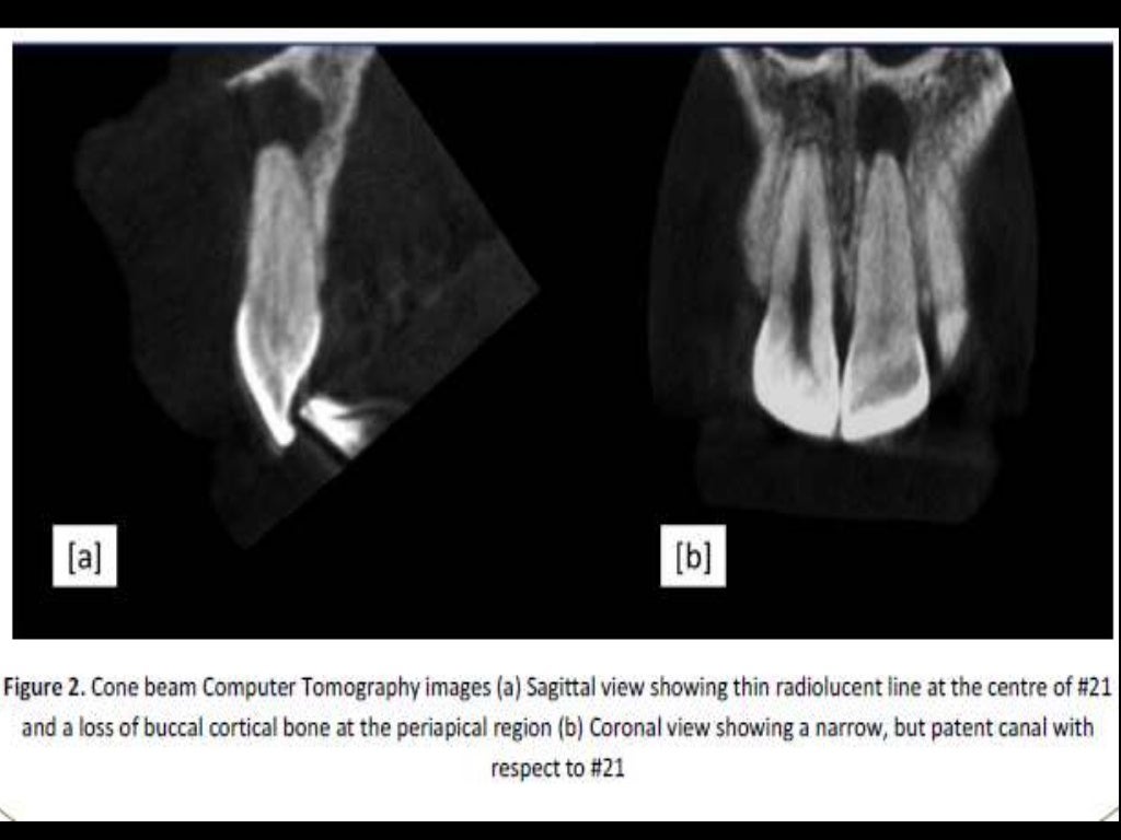 MANAGEMENT OF CALCIFIED PULP CANAL