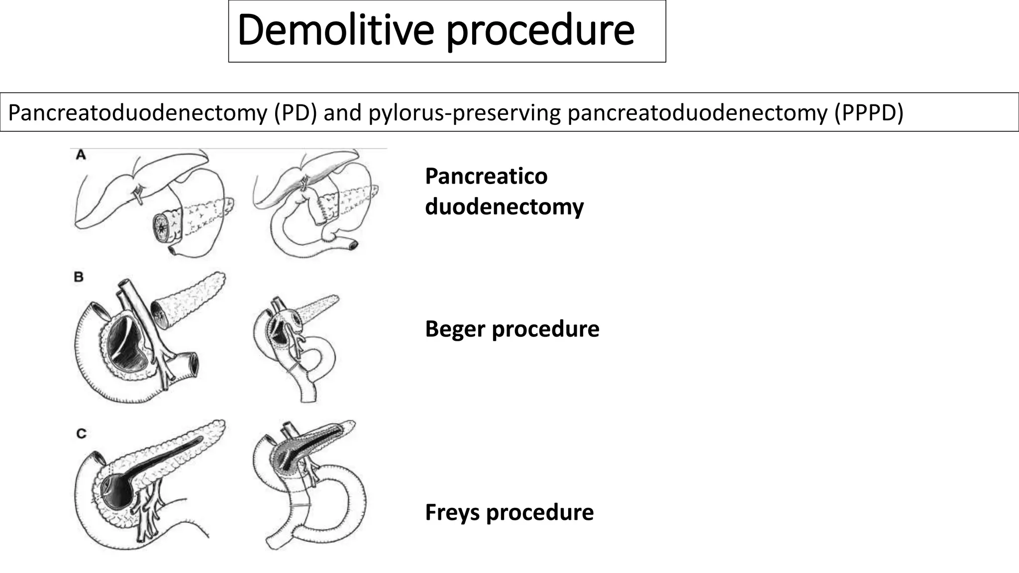 Demolitive procedure
Pancreatoduodenectomy (PD) and pylorus-preserving pancreatoduodenectomy (PPPD)
Pancreatico
duodenectomy
Beger procedure
Freys procedure
 