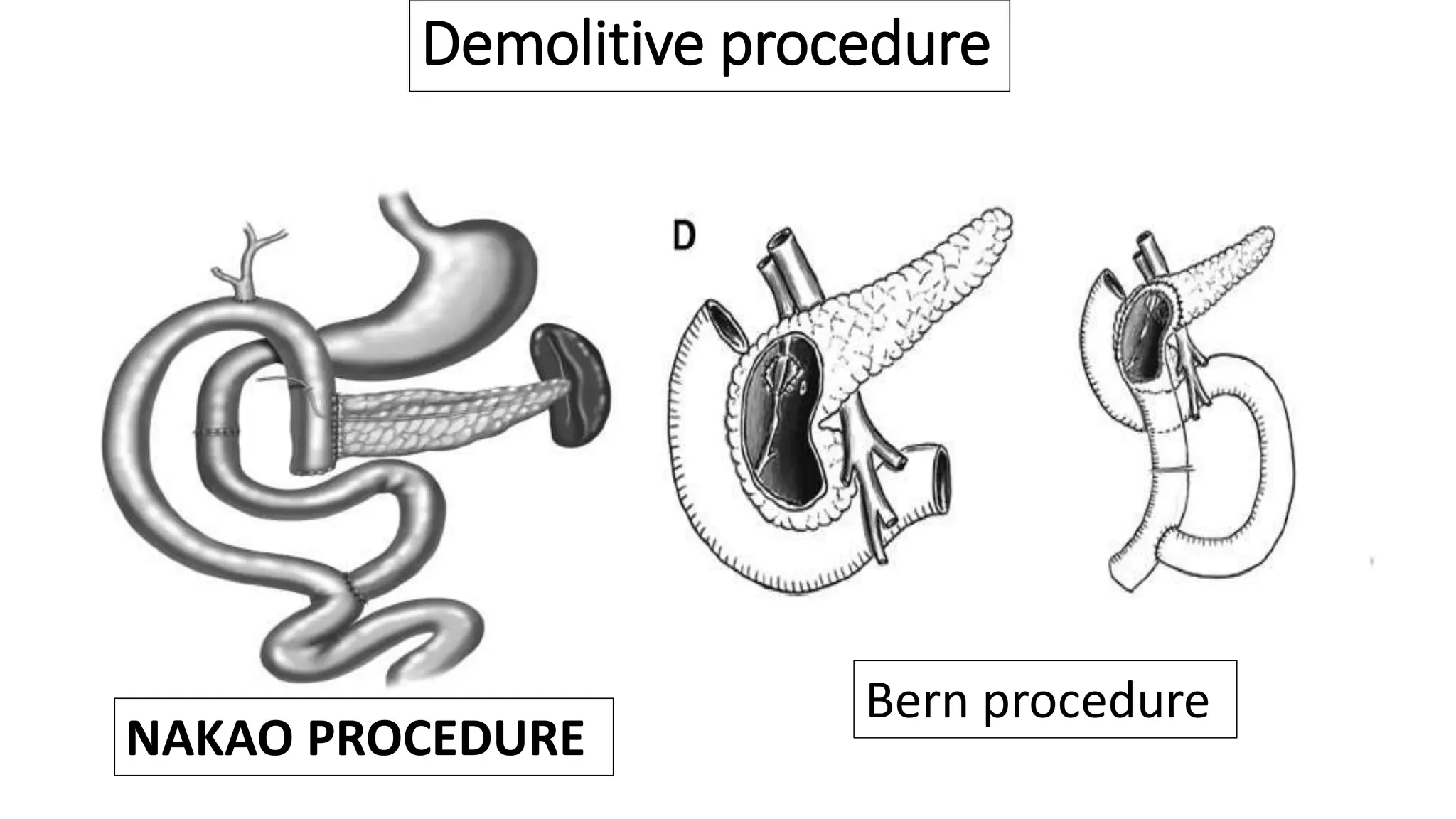 Demolitive procedure
Bern procedure
NAKAO PROCEDURE
 