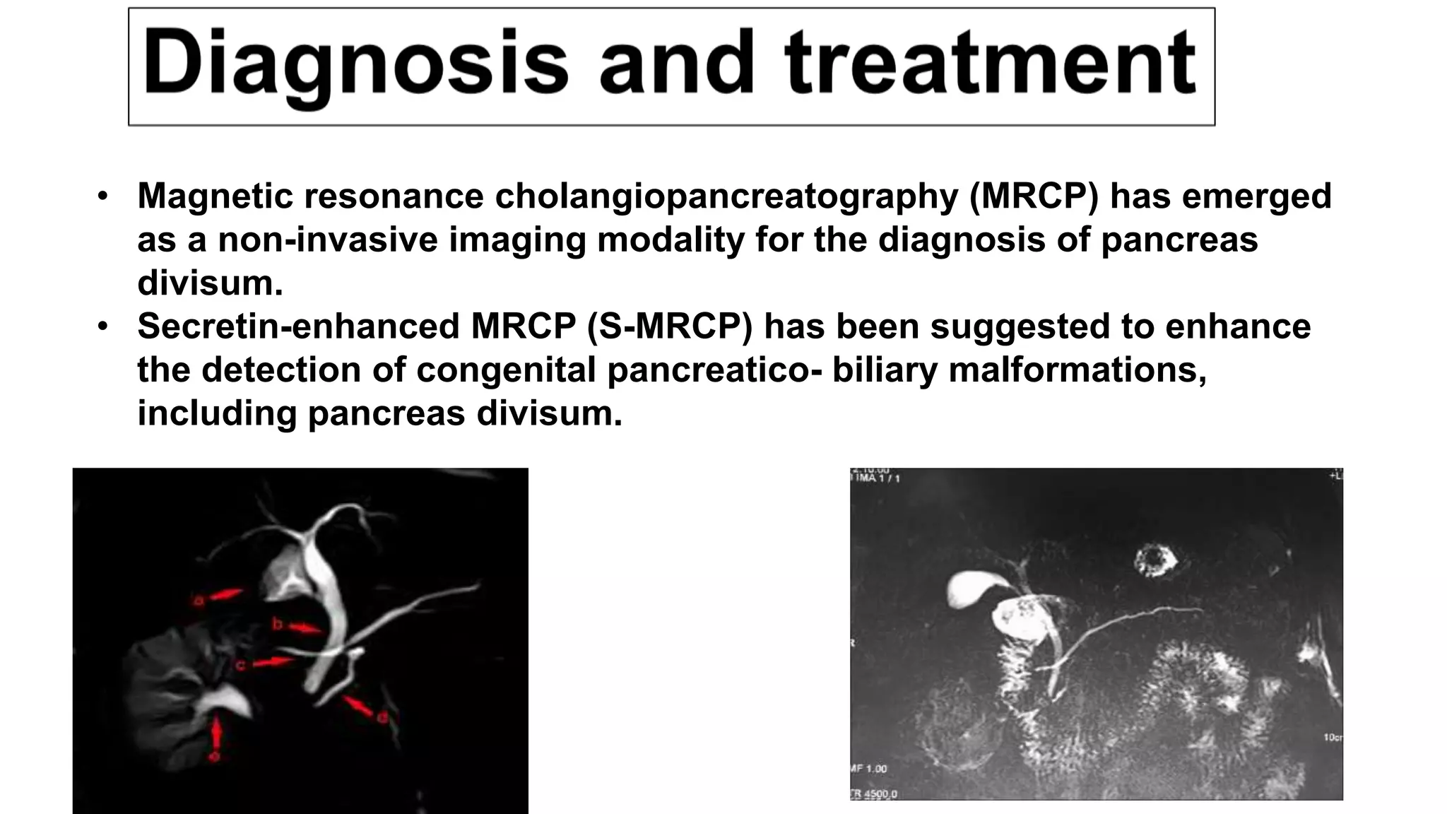 • Magnetic resonance cholangiopancreatography (MRCP) has emerged
as a non-invasive imaging modality for the diagnosis of pancreas
divisum.
• Secretin-enhanced MRCP (S-MRCP) has been suggested to enhance
the detection of congenital pancreatico- biliary malformations,
including pancreas divisum.
 