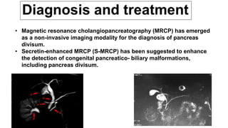 • Magnetic resonance cholangiopancreatography (MRCP) has emerged
as a non-invasive imaging modality for the diagnosis of pancreas
divisum.
• Secretin-enhanced MRCP (S-MRCP) has been suggested to enhance
the detection of congenital pancreatico- biliary malformations,
including pancreas divisum.
 