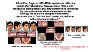 Alfred Paul Rogers (1873–1959), sometimes called the
father of myofunctional therapy, wrote: “It is a well-
recognized biological fact that structural form is influenced
by pressures due to abnormal neuromuscular
Intraoral photographs with
Twin block appliance.
Post twin block facial
photograph.
Class II div 1 malocclusion Effect of Twin Block Appliance on a Growing Patient – A
Case Report
activity; the converse being true that normal
pressures, due to function, tend toward normal form
in the osseous structures.”
 