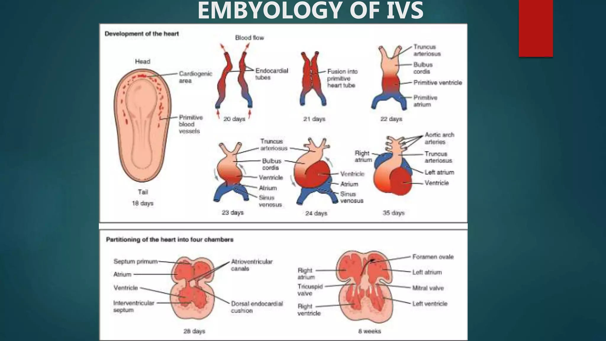 Vsd Incedence PATHOPHYSIOLOGY ,NATURAL HISTORY OF VSD | PPTX