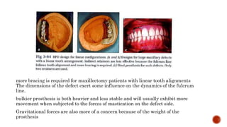 Sharp Linear Defect Tooth PROSTHODONTIC MANAGEMENT OF MAXILLECTOMY/ OBTURATORS PART 2 | PPTX