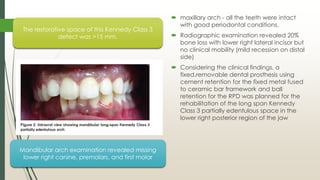 JOURNAL CLUB PRESENTATION IN PROSTHODONTICS on ANDREW'S BRIDGE SYSTEM | PDF