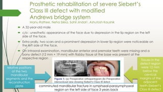 Siberet Ridge Defect JOURNAL CLUB PRESENTATION IN PROSTHODONTICS on ANDREW'S BRIDGE SYSTEM | PDF