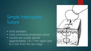 Simple Interrupted
Suture.
• Gold standard
• most commonly employed suture
• Sutures are usually placed
approximately 5 to 7 mm apart and
to 2 mm from the skin edge
 