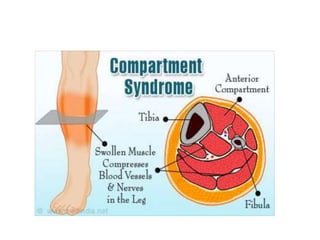Management
• The only treatment for a compartment syndrome is a
fasciotomy
• A delay in performing a fasciotomymay result ...