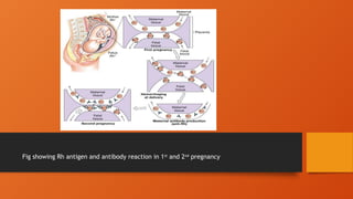 Fig showing Rh antigen and antibody reaction in 1st
and 2nd
pregnancy
 