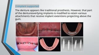 2-implant supported
The denture appears like traditional prosthesis. However, that part
of the dentureoverlying implants is modified to retain various
attachments that receive implant extentions projecting above the
gum.
 