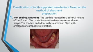 Classification of tooth supported overdenture Based on the
method of abutment
preparation:
1. Non coping abutment :The tooth is reduced to a coronal height
of 2 to 3 mm. The crown is contoured to a convex or dome
shape. The tooth is endodontically treated and filled with
amalgam or composite restoration.
 