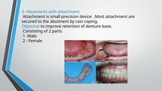 3- Abutments with attachment
Attachment is small precision device ,Most attachment are
secured to the abutment by cast coping.
Objective to improve retention of denture base.
Consisting of 2 parts
1 -Male
2 - Female
 