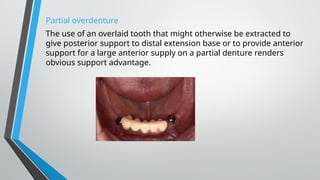 Partial overdenture
The use of an overlaid tooth that might otherwise be extracted to
give posterior support to distal extension base or to provide anterior
support for a large anterior supply on a partial denture renders
obvious support advantage.
 