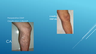 CASE-1
Preoperative CEAP
Classification: C4EpAsPr
6 month postoperative clinical
CEAP classification C0
 