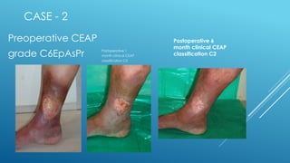 CASE - 2
Preoperative CEAP
grade C6EpAsPr Postoperative 1
month clinical CEAP
classification C5
Postoperative 6
month clinical CEAP
classification C2
 
