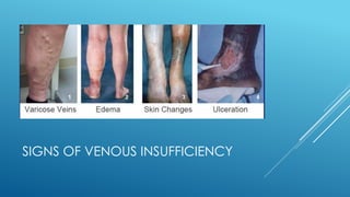 SIGNS OF VENOUS INSUFFICIENCY
 