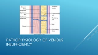 PATHOPHYSIOLOGY OF VENOUS
INSUFFICIENCY
 