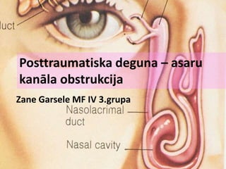 Posttraumatiska deguna – asaru
kanāla obstrukcija
Zane Garsele MF IV 3.grupa
 
