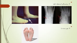 
3-‫استخوان‬ ‫برجستگي‬‫ناوي‬

4-‫پا‬ ‫شدن‬ ‫پهن‬
 