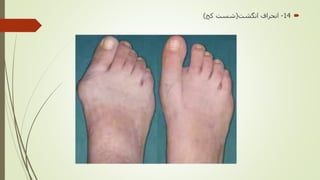 14-‫انگشت‬ ‫انحراف‬(‫كج‬ ‫شست‬)
 