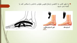 ‫پا‬ ‫كف‬ ‫صافي‬ ‫پا‬ ‫داخلي‬ ‫طولي‬ ‫قوس‬ ‫ارتفاع‬ ‫كاهش‬ ‫به‬ ‫كلي‬ ‫طور‬ ‫به‬
‫شود‬ ‫مي‬ ‫گفته‬.
 