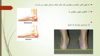 ‫است‬ ‫زير‬ ‫موارد‬ ‫شامل‬ ‫صاف‬ ‫پاي‬ ‫كف‬ ‫عوارض‬ ‫و‬ ‫عاليم‬ ‫كلي‬ ‫طور‬ ‫به‬:
1-‫طولي‬ ‫قوس‬ ‫كاهش‬‫پا‬

2-‫به‬ ‫پاشنه‬ ‫چرخش‬‫خارج‬
 