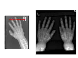 radiological signs of in orthopaedics | PPTX