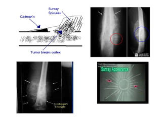 radiological signs of in orthopaedics | PPTX