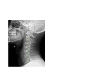 radiological signs of in orthopaedics | PPTX