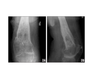 radiological signs of in orthopaedics | PPTX