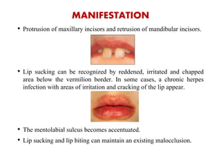 MANIFESTATION
• Protrusion of maxillary incisors and retrusion of mandibular incisors.
• Lip sucking can be recognized by reddened, irritated and chapped
area below the vermilion border. In some cases, a chronic herpes
infection with areas of irritation and cracking of the lip appear.
• The mentolabial sulcus becomes accentuated.
• Lip sucking and lip biting can maintain an existing malocclusion.
 