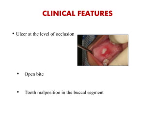 CLINICAL FEATURES
• Ulcer at the level of occlusion
• Open bite
• Tooth malposition in the buccal segment
 