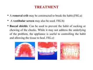 TREATMENT
• A removal crib may be constructed to break the habit.(FIG.a)
• A vestibular screen may also be used. FIG.b)
• Buccal shields: Can be used to prevent the habit of sucking or
chewing of the cheeks. While it may not address the underlying
of the problem, the appliance is useful to controlling the habit
and allowing the tissue to heal. FIG.c)
 