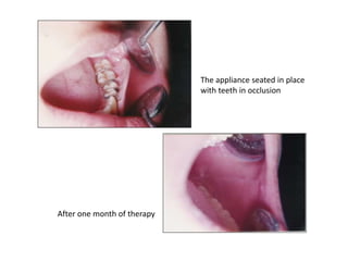 The appliance seated in place
with teeth in occlusion
After one month of therapy
 