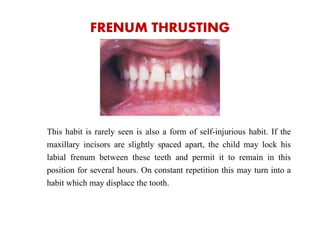 FRENUM THRUSTING
This habit is rarely seen is also a form of self-injurious habit. If the
maxillary incisors are slightly spaced apart, the child may lock his
labial frenum between these teeth and permit it to remain in this
position for several hours. On constant repetition this may turn into a
habit which may displace the tooth.
 