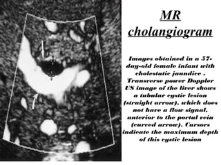 MR
cholangiogram
Images obtained in a 57-
day-old female infant with
cholestatic jaundice .
Transverse power Doppler
US image of the liver shows
a tubular cystic lesion
(straight arrow), which does
not have a flow signal,
anterior to the portal vein
(curved arrow). Cursors
indicate the maximum depth
of this cystic lesion
 