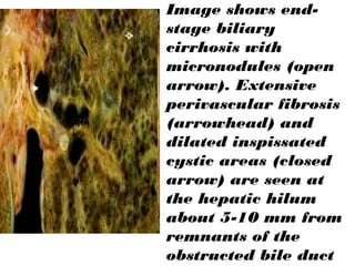 Image shows end-
stage biliary
cirrhosis with
micronodules (open
arrow). Extensive
perivascular fibrosis
(arrowhead) and
dilated inspissated
cystic areas (closed
arrow) are seen at
the hepatic hilum
about 5-10 mm from
remnants of the
obstructed bile duct
 
