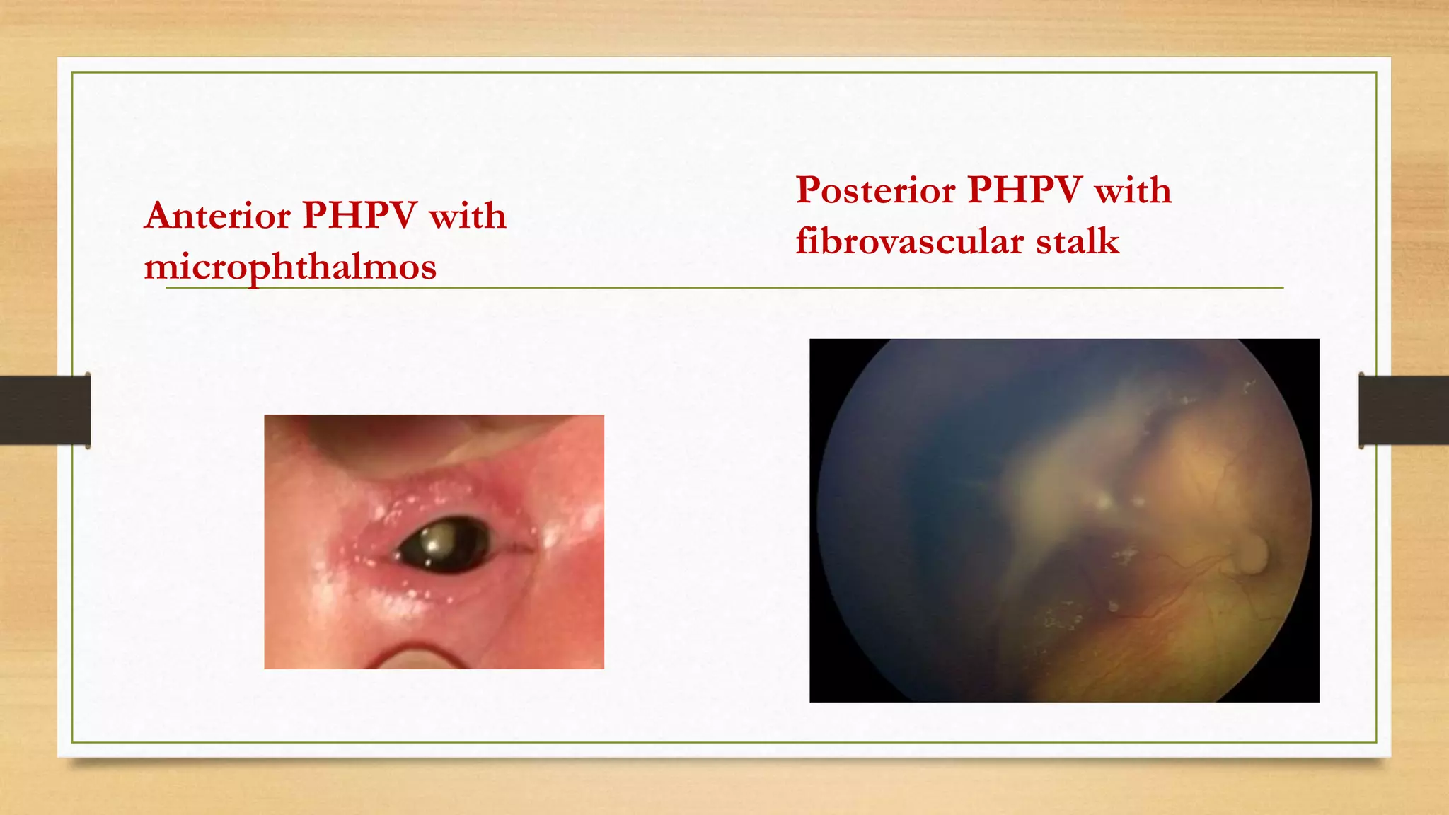 Pphpv Eye PERSISTENT HYPERPLASTIC PRIMARY VITREOUS | PPTX