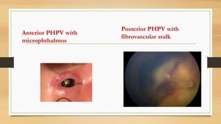 Anterior PHPV with
microphthalmos
Posterior PHPV with
fibrovascular stalk
 