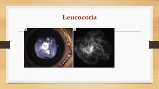 Leucocoria
 