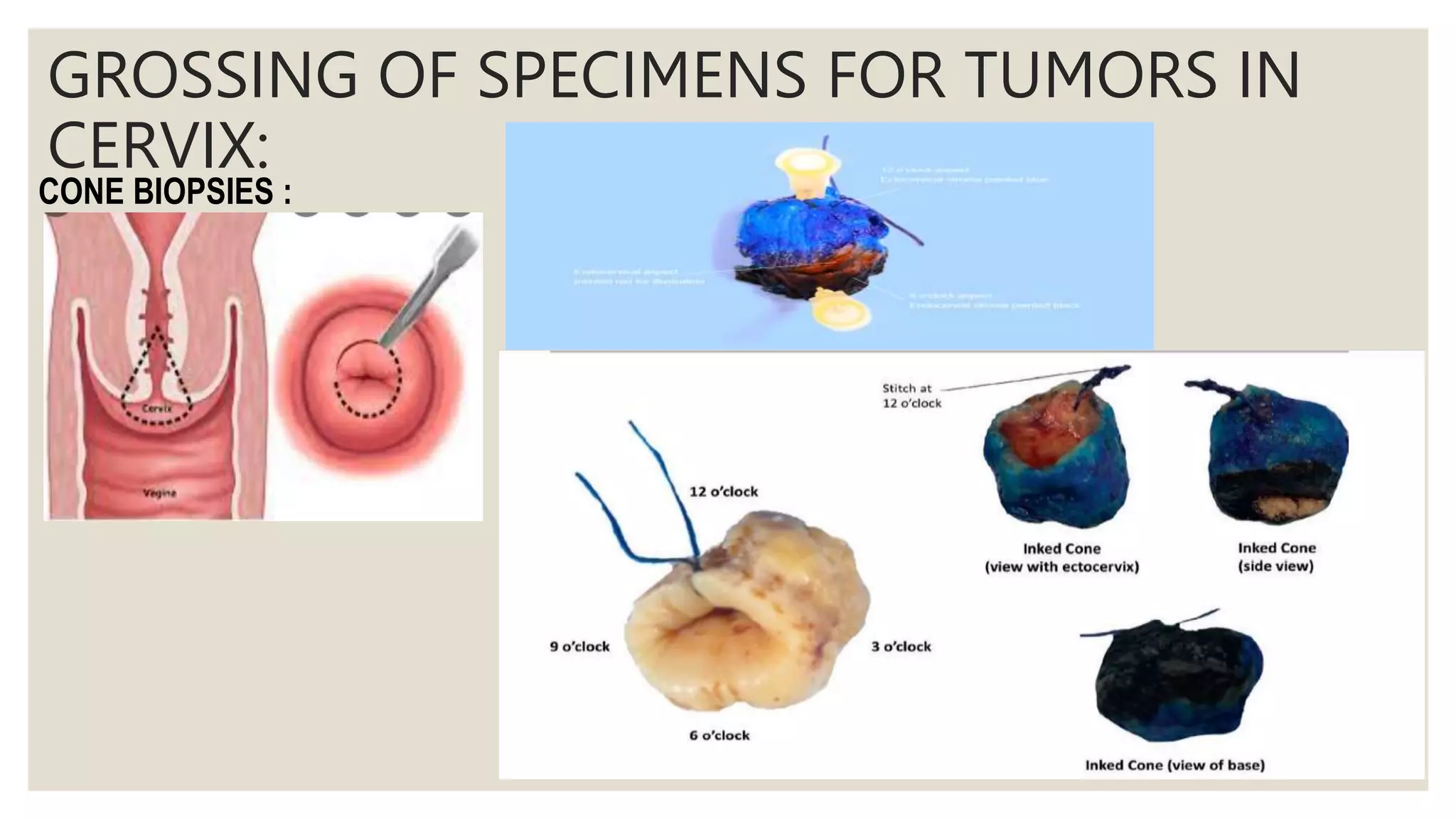 Grossing of hysterectomy specimens PPTX