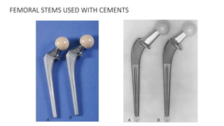 FEMORAL STEMS USED WITH CEMENTS
 