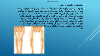  Jenu varum

‫پرانتزی‬ ‫زانوی‬ ‫ناهنجاری‬

‫درشت‬ ‫(ان‬
‫و‬‫استخ‬ ‫و‬ ‫ران‬ ‫داخلی‬ ‫جانب‬ ‫شدن‬ ‫دار‬ ‫زاویه‬ ‫پرانتزی‬ ‫زانوی‬
‫مواقع‬ ‫در‬ ‫زانوها‬ ‫شود‬ ‫می‬ ‫باعث‬ ‫که‬ ‫است‬ ‫زانو‬ ‫مفصل‬ ‫ناحیه‬ ‫در‬ ‫نی‬
‫در‬ ‫بدن‬ ‫میانی‬ ‫خط‬ ‫به‬ ‫نسبت‬ ‫داخلی‬ ‫های‬ ‫قوزک‬ ‫از‬ ‫دورتر‬ ‫ایستادن‬
‫های‬ ‫کندیل‬ ‫بین‬ ‫فاصله‬ ‫گیری‬ ‫اندازه‬ .‫گیرند‬ ‫قرار‬ ‫فرونتال‬ ‫صفحه‬
‫زانوی‬ .‫کند‬ ‫آشکار‬ ‫را‬ ‫پرانتزی‬ ‫پای‬ ‫وجود‬ ‫تواند‬ ‫می‬ ‫ها‬ ‫ران‬ ‫داخلی‬
‫و‬ ‫ران‬ ‫مفاصل‬ ‫در‬ ‫وضعیتی‬ ‫تغییرات‬ ‫دلیل‬ ‫به‬ ‫است‬ ‫ممکن‬ ‫پرانتزی‬
‫اندام‬ ‫در‬ ‫انحرافی‬ ‫های‬ ‫وضعیت‬ ‫از‬ ‫بسیاری‬ .‫آید‬ ‫وجود‬ ‫به‬ ‫پا‬ ‫مچ‬
‫رخ‬ ‫پرانتزی‬ ‫زانوی‬ ‫عارضه‬ ‫بروز‬ ‫دلیل‬ ‫به‬ ‫است‬ ‫ممکن‬ ‫نیز‬ ‫تحتانی‬
.‫دهد‬
 