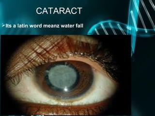 catract | PPT