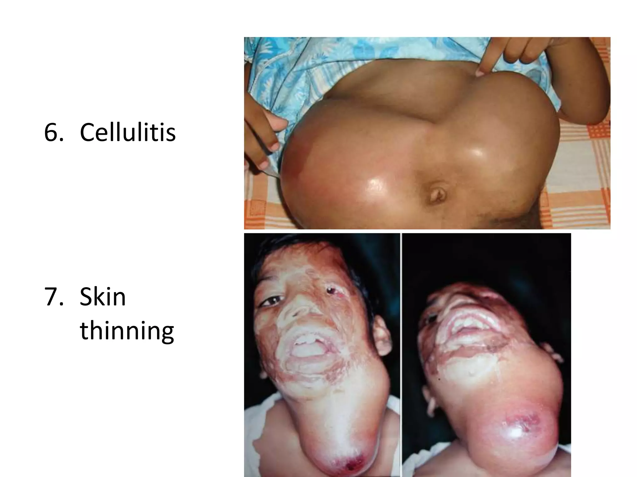 6. Cellulitis
7. Skin
thinning
 